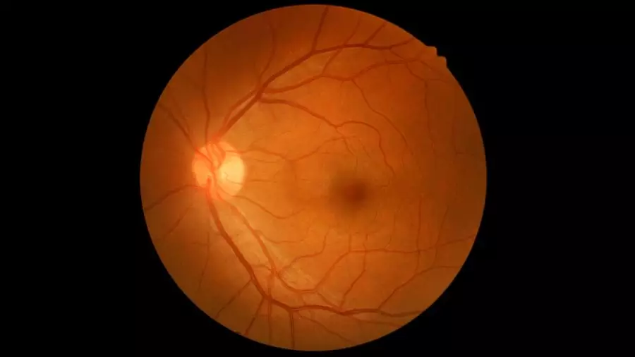 fundus.webp